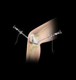 Knee Arthroscopy