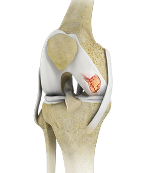 Cartilage Restoration