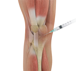 Knee Injections