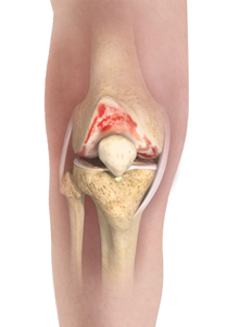 Conservative Treatment for Osteoarthritis