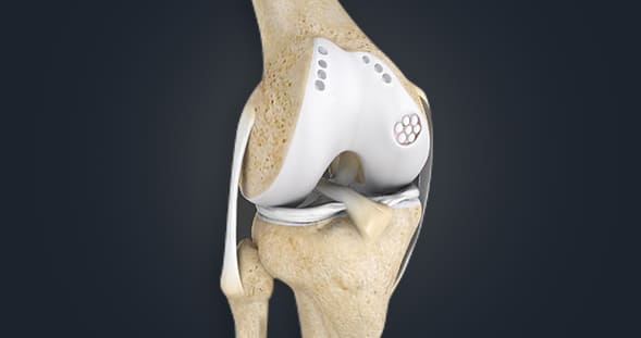 Cartilage Restoration